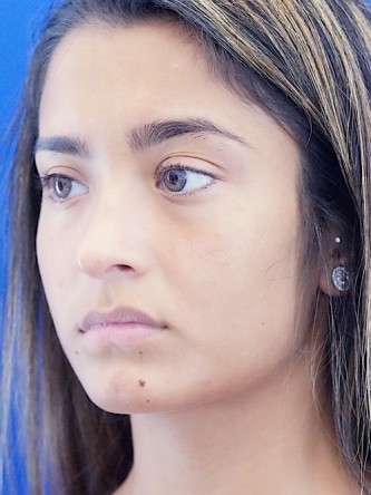 Voluptuous Lip Enhancement* — Before