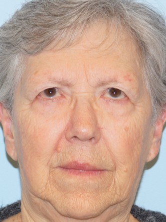 Endoscopic Browlift1* — Before