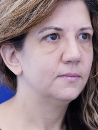 Extended Lower Blepharoplasty* — Before