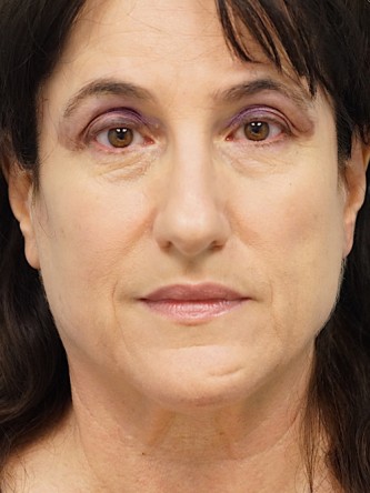 Mini Face and Neck Lift* — Before