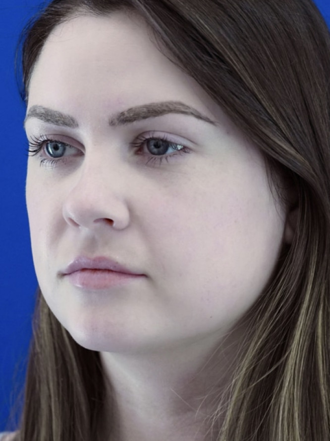 Nasal Tip and Narrow Cheek — Before