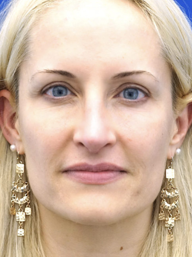 Nasal Profile Finesse — After