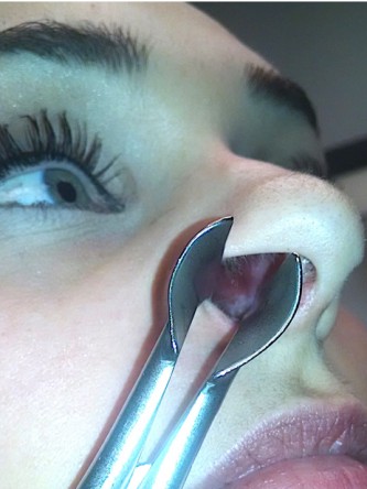Nasal Septal Perforation1* — After