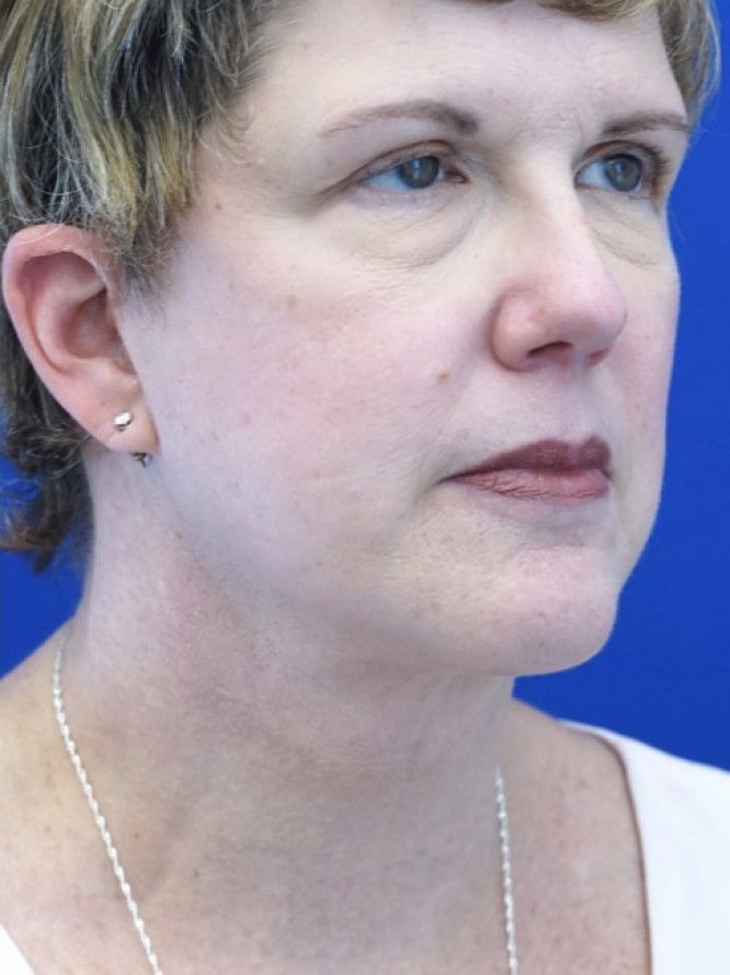 Facelift Platysmaplasty with Subplatysmal Lipectomy — After