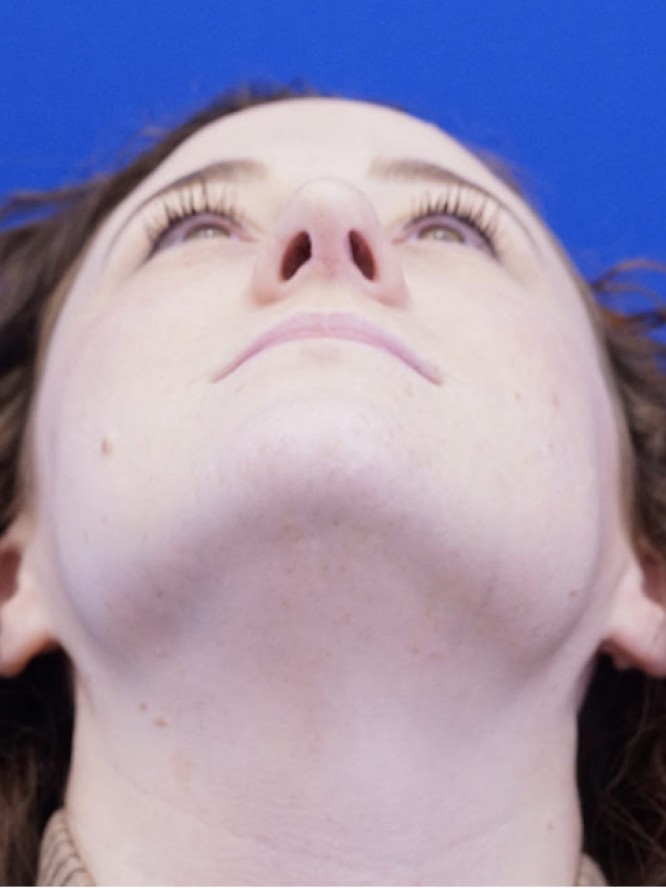 Finesse Nasal Contour — After