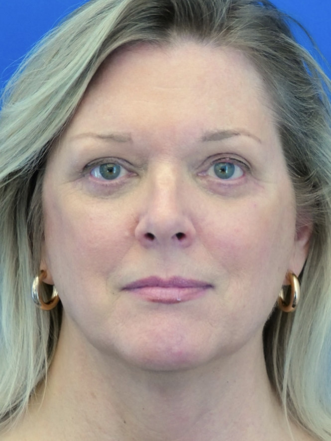 Case 6655: after Endoscopic Browlift, Quad Blepharoplasty