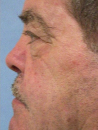 Saddle Nose – Repair Using Ear Cartilage* — After