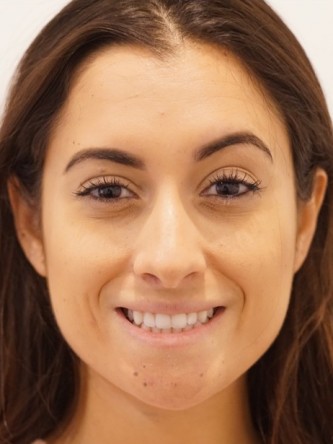 Restylane Silk to Volumize Lower Lip* — Before