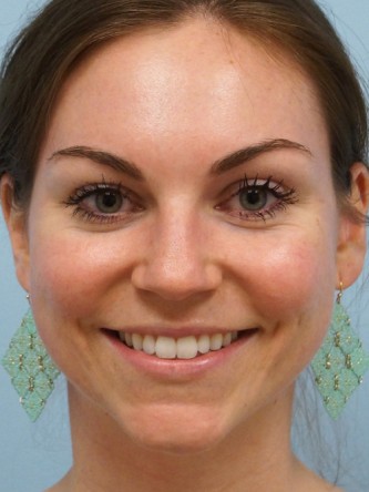 Fractional CO2 Laser Skin Resurfacing1* — After