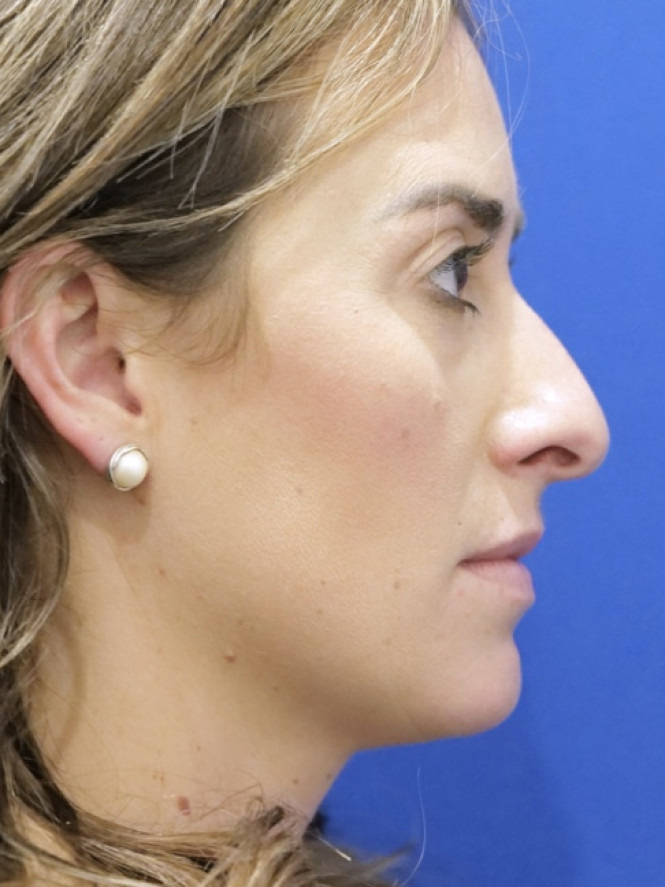 Preservation Rhinoplasty — Before