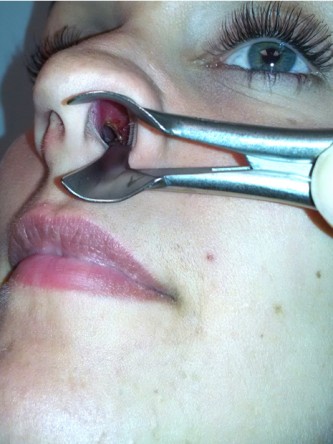 Nasal Septal Perforation1* — Before