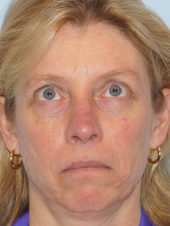 Upper Eyelid Droop1 (Ptosis)* — After