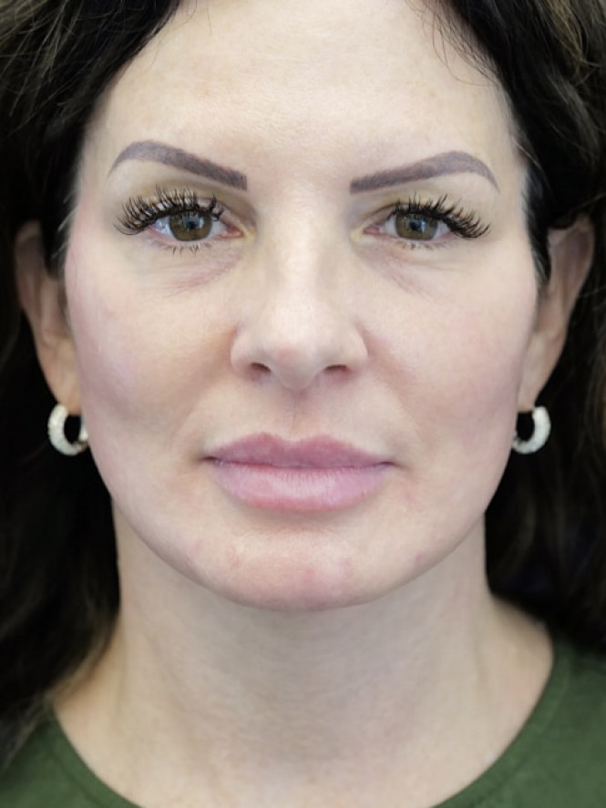 Deep Plane Cheek and Facelift — After