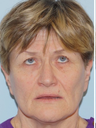 Endoscopic Browlift & Upper Eyelid Droop* — Before