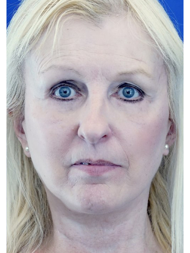 Subciliary Blepharoplasty Fat Reposition — After