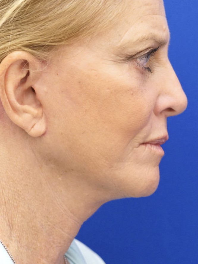 Deep Plane Lower Facelift — After