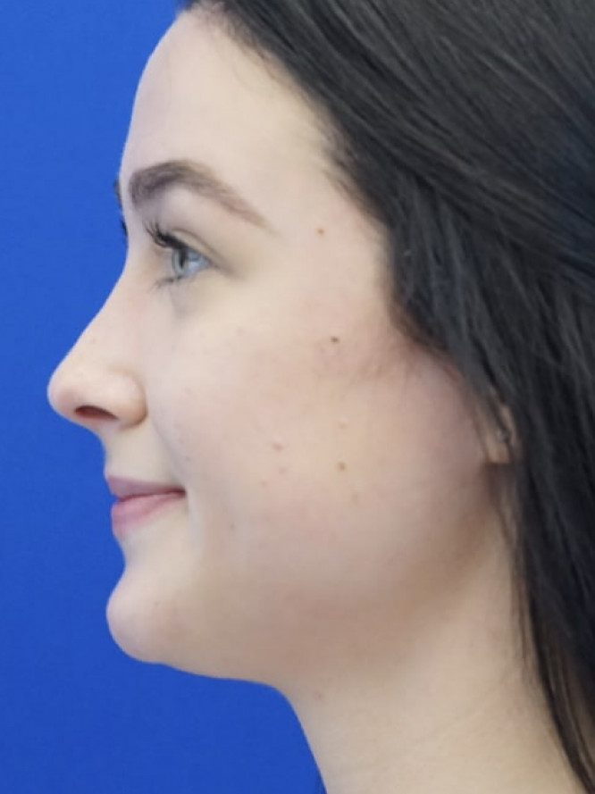 Soften Nasal Bridge — After