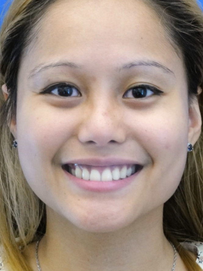 Eyelid Crease Deepening — Before