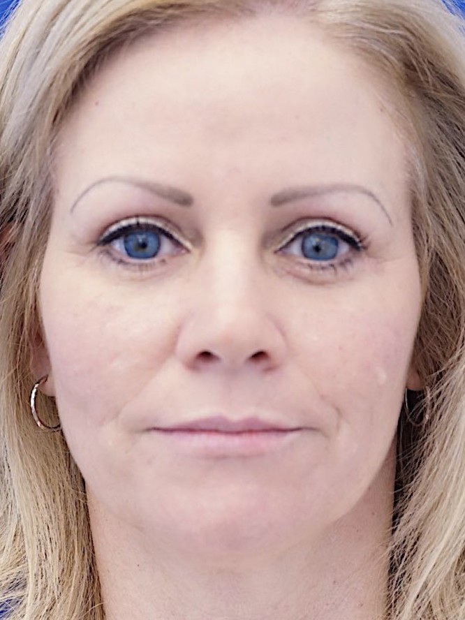 Mild Upper and Lower Lid Skin Trim — After