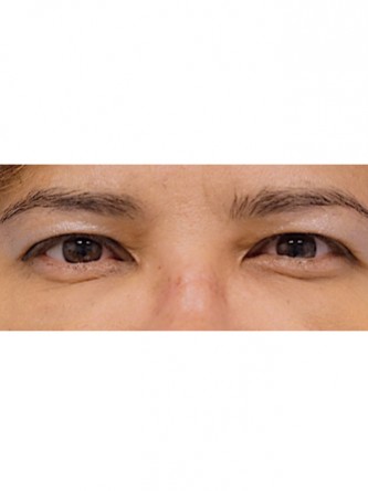 Fat Grafting to Lower Eyelid* — After