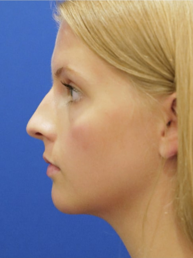 Soften Nasal Appearance — Before