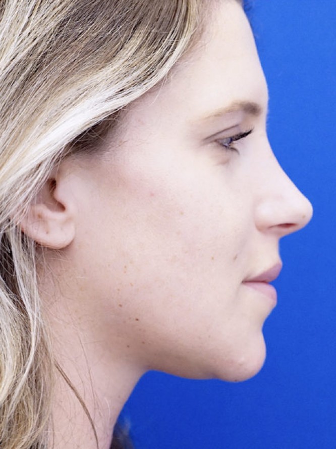 Aesthetic Nasal Profile — After
