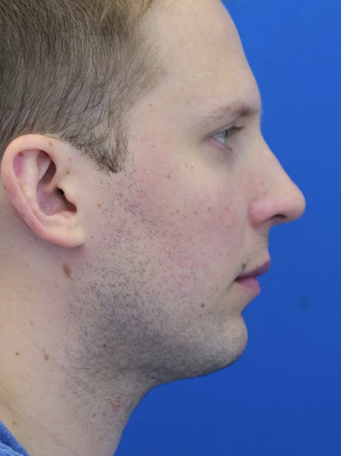 Dorsal Hump and Chin Augmentation — After
