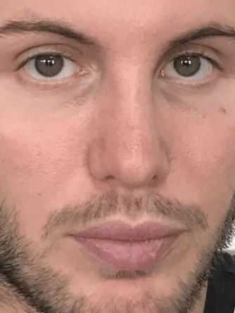 Nasal Upper Third Bony Asymmetry* — After