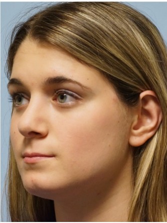 Droopy Tip Endonasal Rhinoplasty* — After