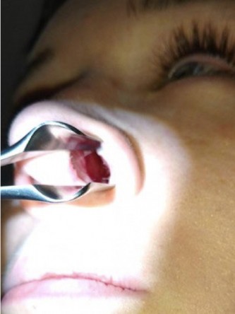 Nasal Profile Irregularity — After