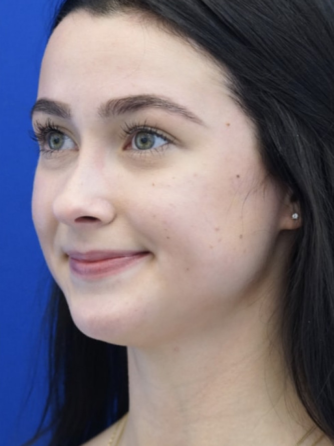 Soften Nasal Bridge — After