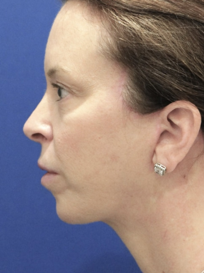 Jowling and Skin Laxity — After