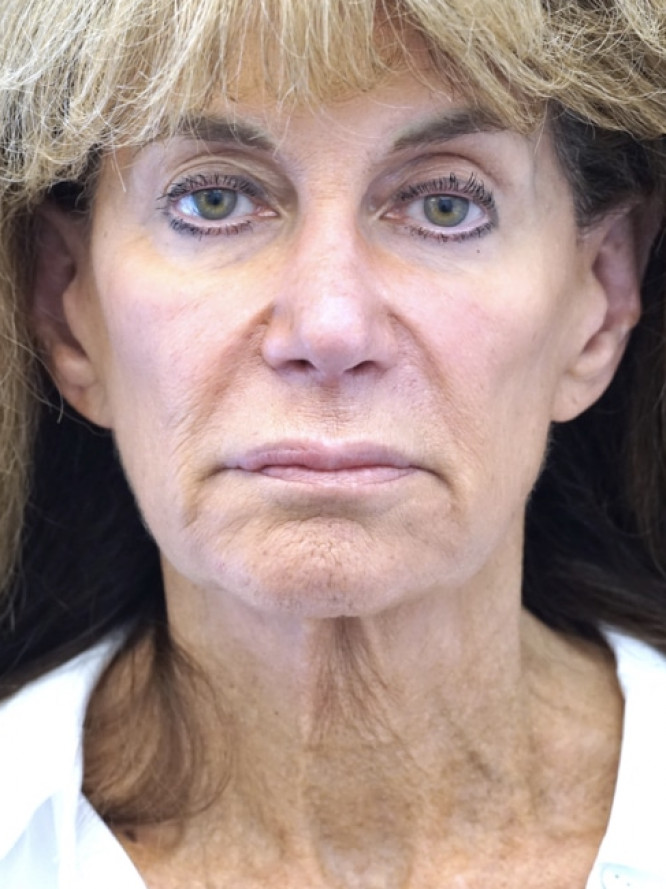 Deep Plane Midface Lift — Before