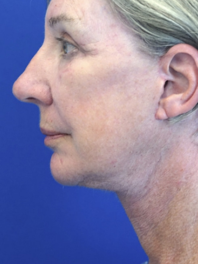 Deep Plane Face and Neck Lift — After