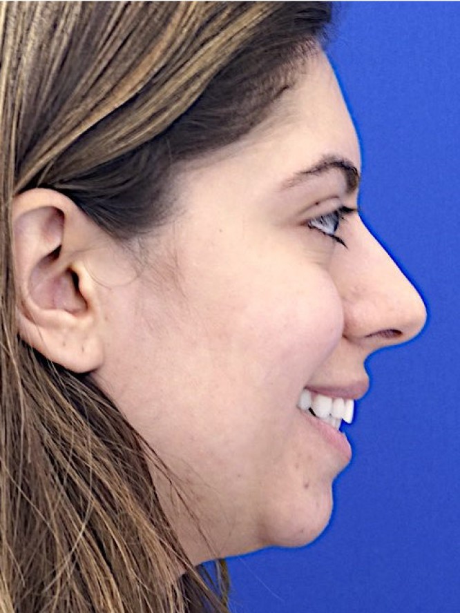 Hump Reduction and Chin Projection — Before