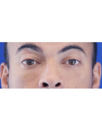 Fat Transfer to Lower Eyelid* — After