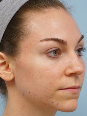 Fractional CO2 Laser Skin Resurfacing1* — Before