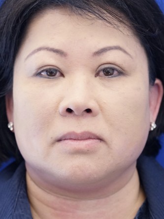 Asian Blepharoplasty — After