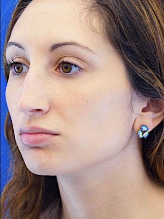 Nasal Profile Aesthetics — Before