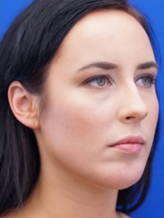 Chin Implant and Upper Lip Filler* — After
