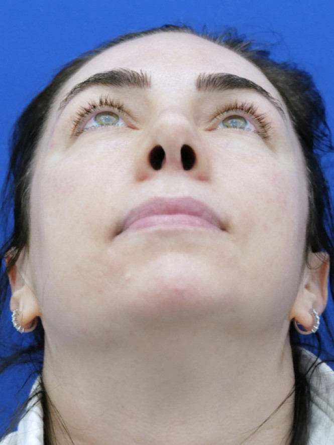 Tip Asymmetry — After