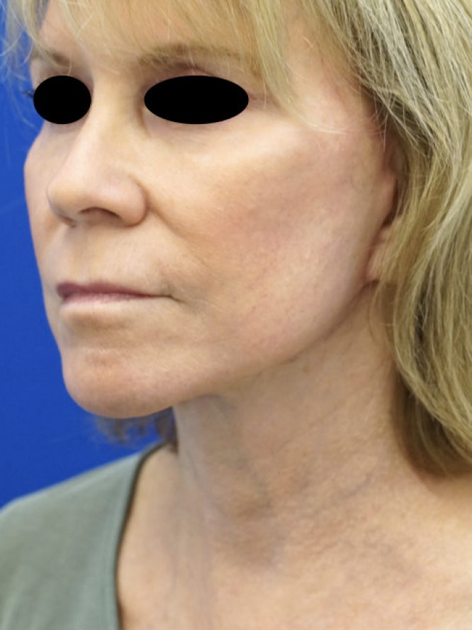 Secondary Deep Plane Facelift — After