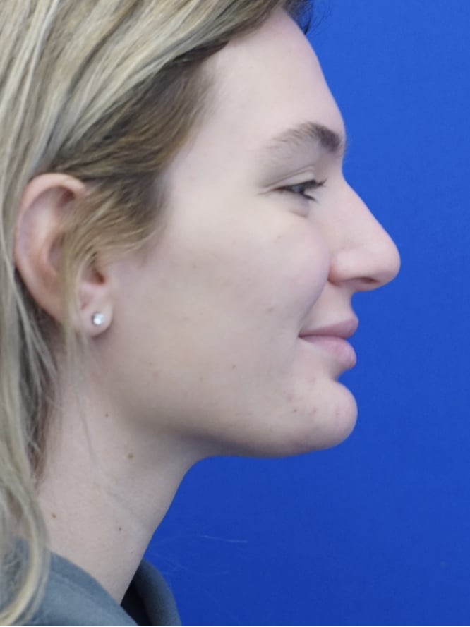 Soft Tissue Chin Reduction — Before