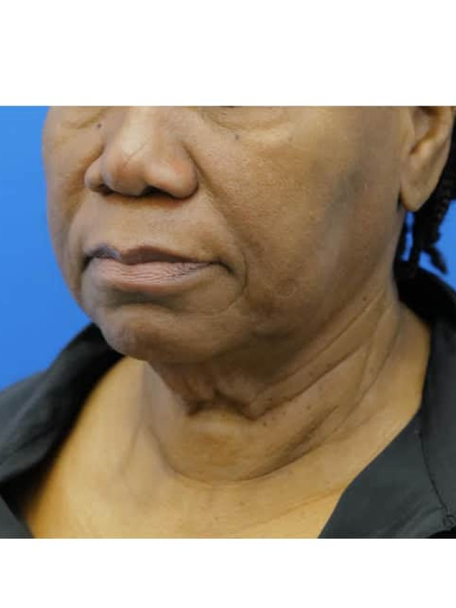 Necklift with Platysmaplasty — Before