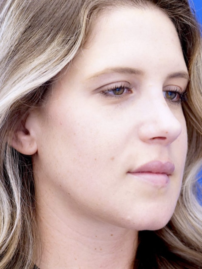 Aesthetic Nasal Profile — After