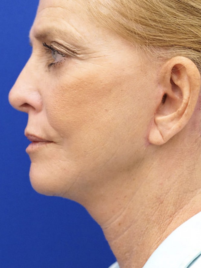 Deep Plane Lower Facelift — After
