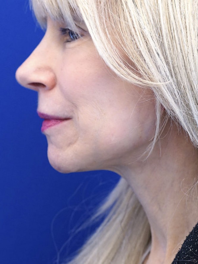 Crisp Jaw and Neck Lines — After