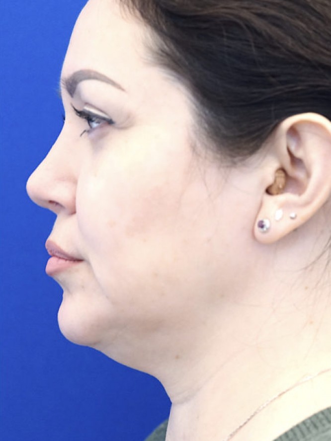 Nasal Tip Asymmetry — After