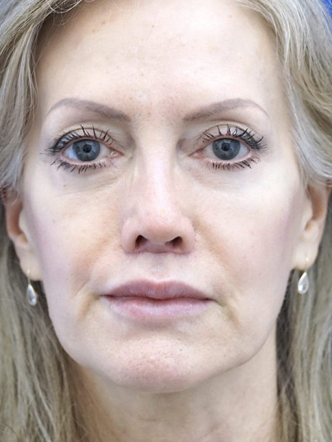 Upper Lip Fullness — After