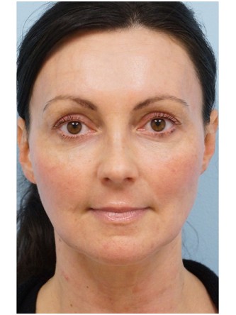Fractional CO2 Laser Skin Resurfacing2* — After